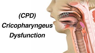 Cricopharyngeus Dysfunction (CPD) Causing Dysphagia or Trouble Swallowing