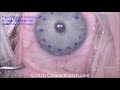 techniques to open dmek grafts corneal endothelial transplantation