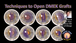 Techniques to Open DMEK grafts (corneal endothelial transplantation)