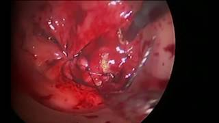 Combined Laparoscopic \u0026 TAMIS LAR in a Morbidly Obese Patient