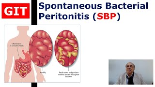 Spontaneous Bacterial Peritonitis (SBP)