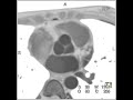 cardiac normal coronary cta 1 of 6