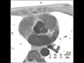 cardiac normal coronary cta 1 of 6