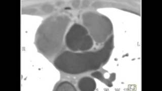 Cardiac: Normal coronary CTA (1 of 6)