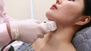 TRUSCULPT ID for Double Chin Reduction