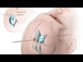 EVD Insertion| External Ventricular Drain| Kocher’s Point| NEUROSURGERY| Dr Anil Kothiwala