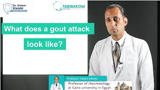 Symptoms of GOUT. What a gout attack looks like