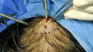 Excision of Infected Sebaceous Cyst-Scalp