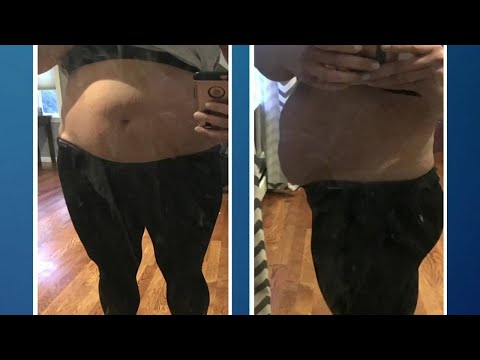 Does C-section bulge go away?