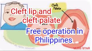 cleft lip, cleft palate free operation in Philippines