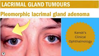 Lacrimal gland tumor-Kanski's clinical ophthalmology #pleomorphic adenoma #eye cancer #eye disease