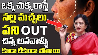 Pigmentation!! Pimples, Dark Skin, Acne Skin in Telugu || SumanTV Women Health & Beauty