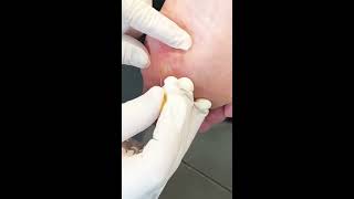 Multiple Puncture Technique Plantar Wart Treatment