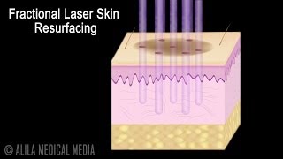 Traditional versus Fractional Laser Skin Resurfacing Procedure Animation.
