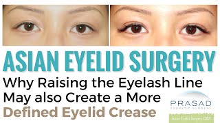 How the Eyelash Line Can be Raised with Eyelid Surgery