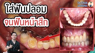 ฟันหน้าสึก ยิ้มไม่สวย พี่หมอแก้อย่างไร ให้กลับมายิ้มสวยอีกครั้ง ?!! | คลายปัญหารากเทียมกับหมอโชค