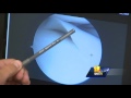 Video: Here's why it's important to repair meniscus tears