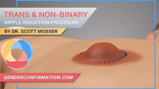 Transgender & Non-binary Nipple Reduction Described by Dr. Scott Mosser