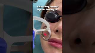 Get Flawless Skin with Fractional CO2 Laser Treatment | Dr. Priyanka Reddy | #Shorts #youtubeshorts