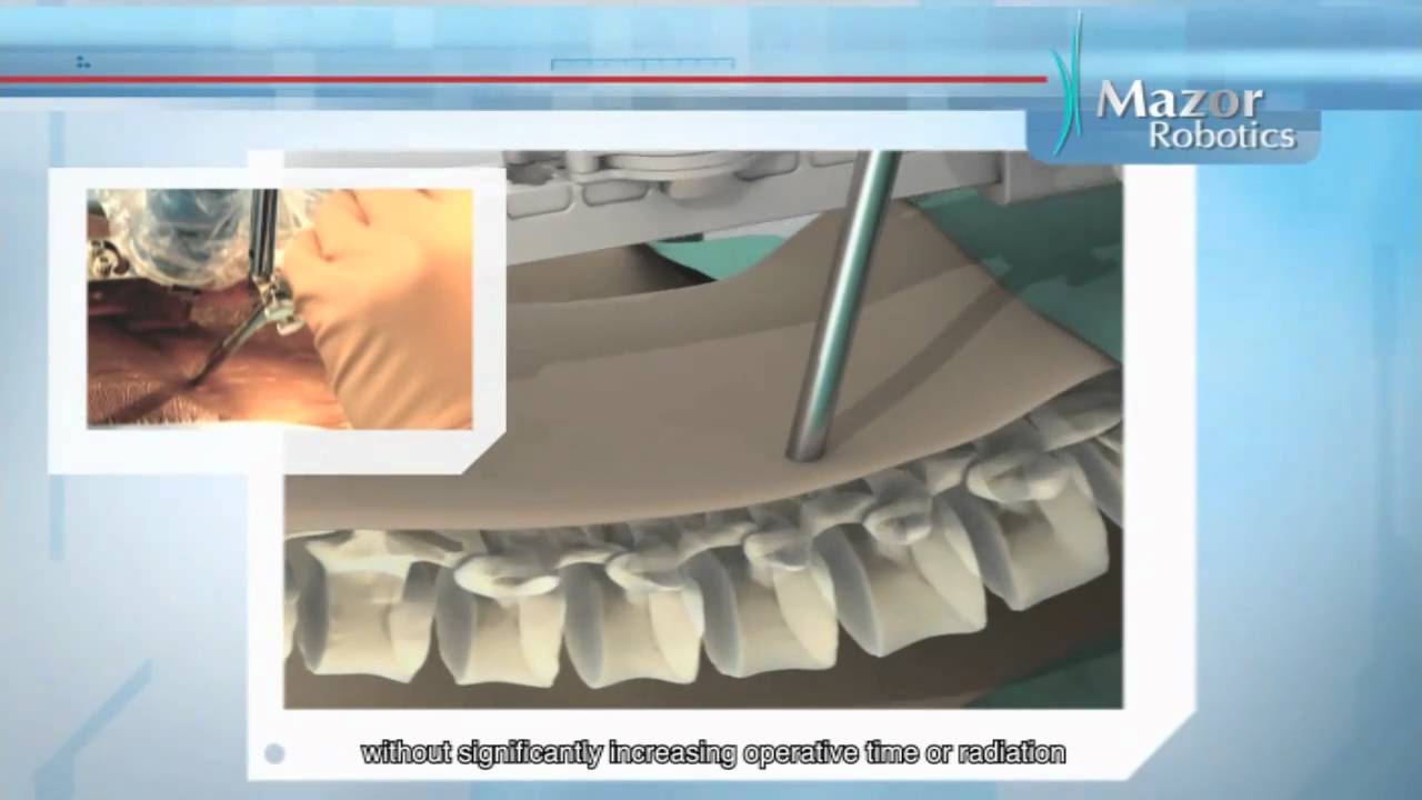 Mazor Robotics Spineassist 2010 Youtube