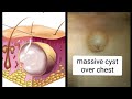 large massive seabaceous cyst over chest | cyst | excision of cyst #youtube #doctor #dr