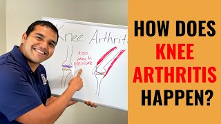 Everything You Need To Know About Knee Arthritis - Symptoms & Causes