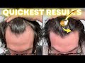 Dermaroller + Minoxidil Hair Regrowth Results | AL GARRIDO