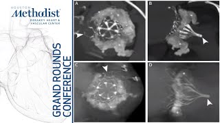 Transcatheter Mitral Valve Replacement: The Journey (Mayra E. Guerrero, MD) June 2, 2022