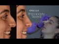 Rhinoplasty Cast Removal - New Nose Reveal with Dr. Kian