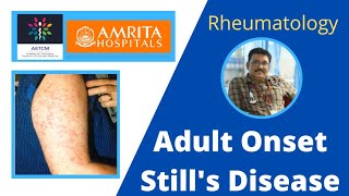 Adult Onset Stills Disease || Yamaguchi criteria