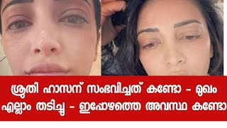 നീരുവച്ച മുഖവും തടിച്ച ചുണ്ടുകളും; ശ്രുതി ഹാസന് എന്തുപറ്റിയെന്ന് ആരാധകർ - Shruthi Hasan