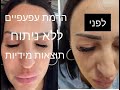 הרמת עפעפיים ללא הזרקות וניתוחים מיותרים