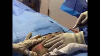 Main Line Plastic Surgery Smartlipo Video