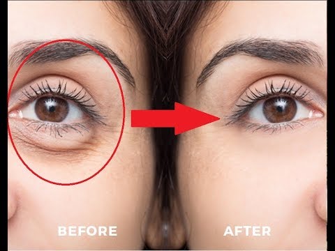 3 Recipes Using Potato to Fight Eye Puffiness 3 Recipes Using Potato to Fight Eye Puffiness