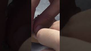 Removable quad helix