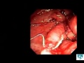 Gastric pouch and stoma reduction using a novel endoscopic device: The Endosurgical Operating System