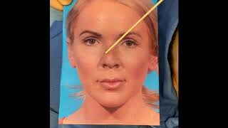 Revision Rhinoplasty Pollybeak correction