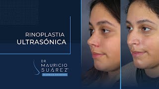 Un impresionante cambio con nuestra rinoplastia ultrasónica | Dr. Mauricio Suárez