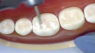 REST 528 - All metal Crown # 19 - Occlusal Reduction