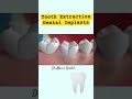 tooth extraction and implant replacement