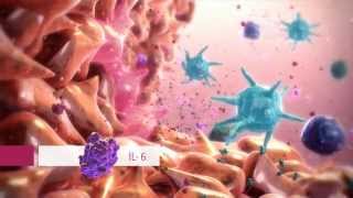 Rheumatoid arthritis - hybrid medical animations