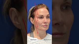 Jaw Dropping Facelift At Age 65