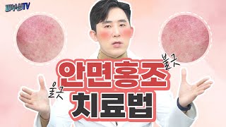 안면홍조 없애는법! - 예방과 레이저 치료! [피부과전문의 피부심]