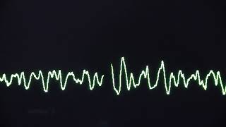 Ventricular fibrillation causes cardiac arrest.