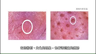 我有酒糟肌能做杏仁酸換膚嗎？