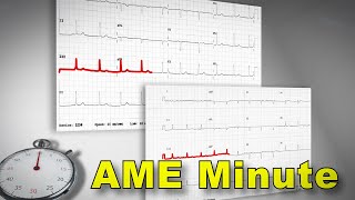 AME Minute: Why did the FAA update the technical requirement for ECGs?