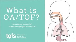 What is Oesophageal Atresia (OA) and Tracheo-Oesophageal Fistula (TOF)? (EA/TEF)