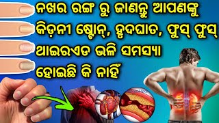 କିଡନୀ ଷ୍ଟୋନ୍, ହାର୍ଟ ଆଟାକ୍, ଥାଇରଏଡ, ଫୁସଫୁସ ସଂକ୍ରମଣ ଲକ୍ଷଣ ନିଜ ନଖର ରଙ୍ଗରୁ ଜାଣନ୍ତୁ, ଜଲଦି ଦେଖନ୍ତୁ ଏମିତି