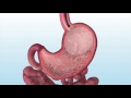 Dr. Matthew Grossman of GANJ discusses the Gastric Balloon