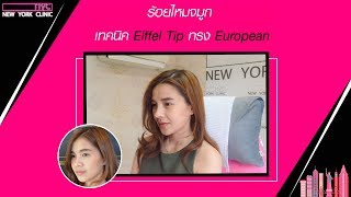 ร้อยไหมจมูก ทรง European Eiffel Tip จมูกโด่ง ปลายพุ่ง ไม่ต้องผ่าตัด โดย คุณหมอจิ๋ง NYC Clinic